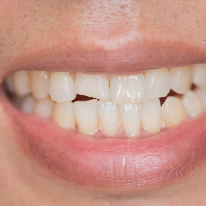 doctor putting silicone invisible transparent braces on woman teeth