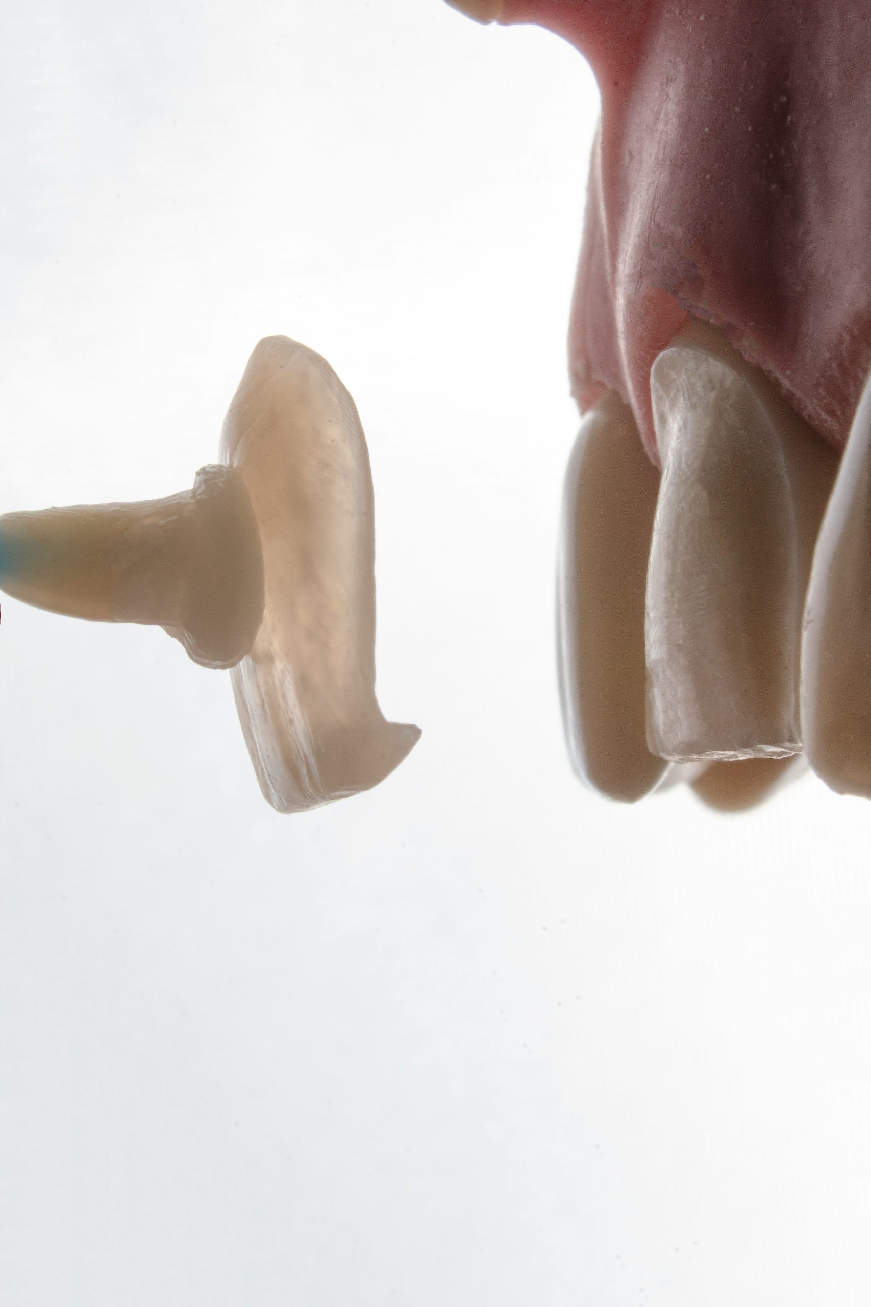 orleans dental implant